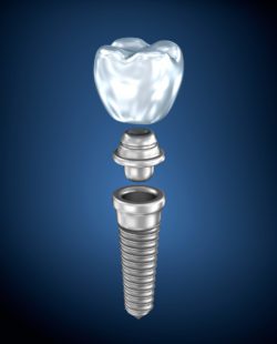 Affordable dental implants in Towson Maryland