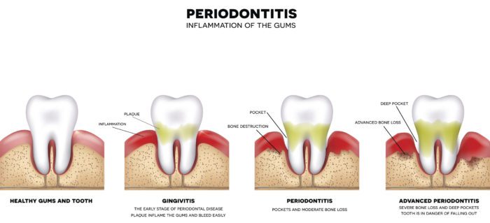 treatment for gum disease in Towson Maryland