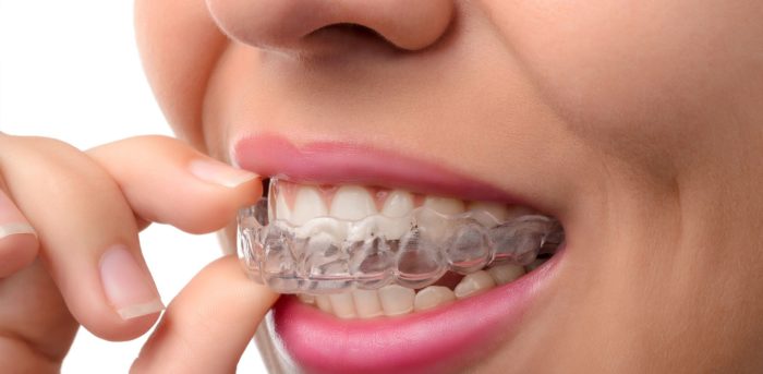 Towson dentist provides Invisalign for teens and adults