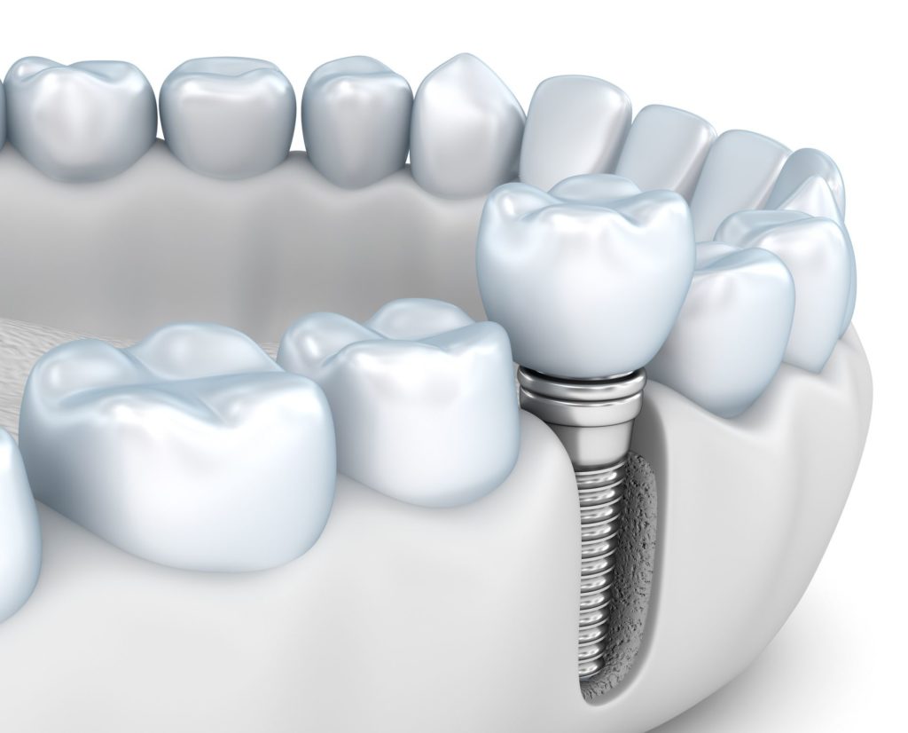 Benefits of Dental Implants in Towson, MD