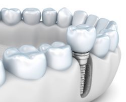 dental implants in Towson, Maryland