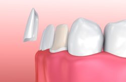 towson, maryland porcelain veneers