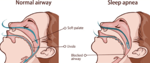 side by side comparison of normal airway versus an airway with sleep apnea dentist in Towson Maryland