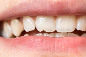 Close-up of teeth with small chip dental bonding cosmetic treatments Towson Maryland