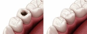 side-by-side of a 3D cavity before and after a dental filling general dentistry dentist in Towson Maryland
