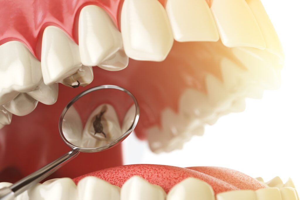 We offer treatment for tooth decay in Towson, MD