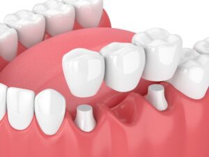 Dental Bridges for Missing Teeth