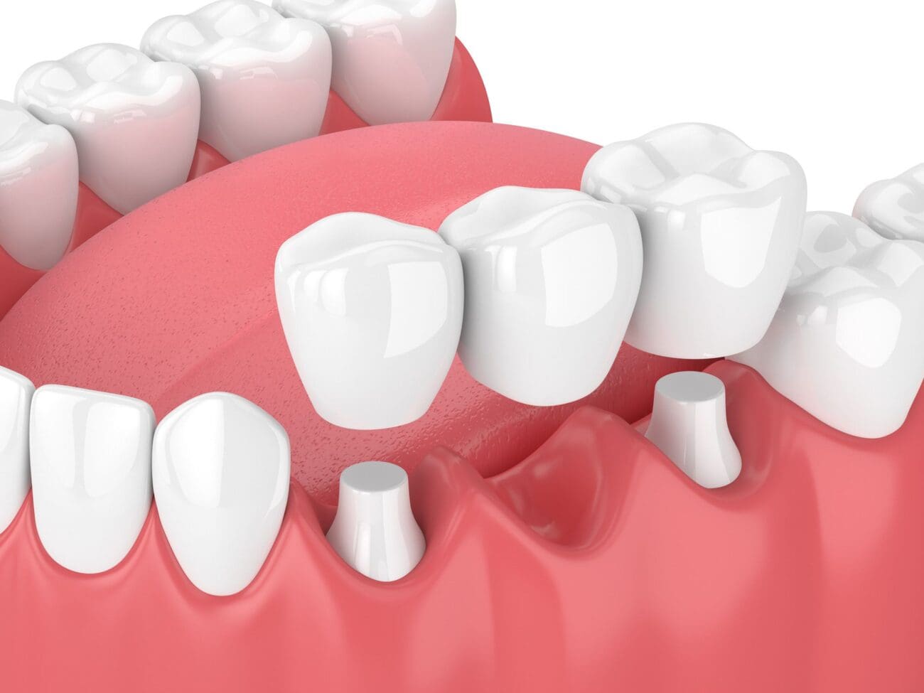 Dental Bridges in Towson MD