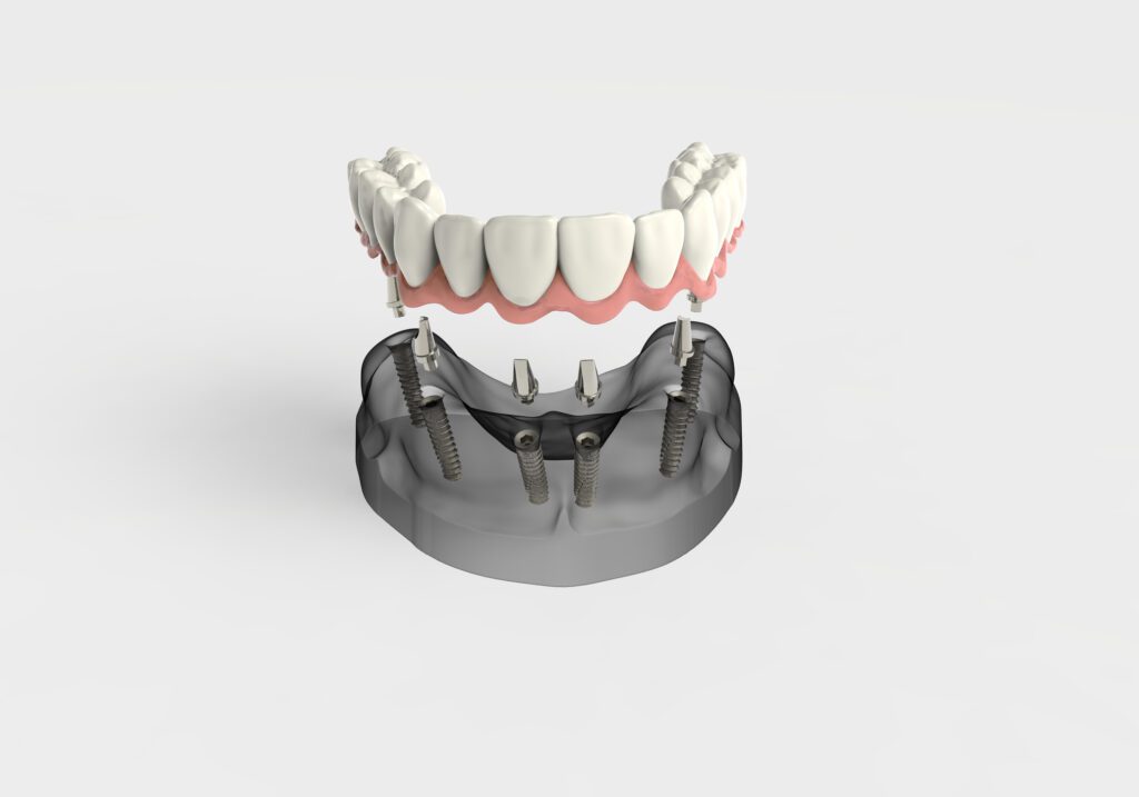 dental implants vs dentures in Towson, MD