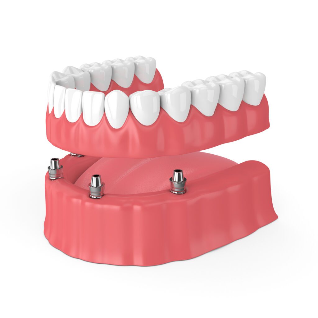 full mouth dental implants in Towson, MD