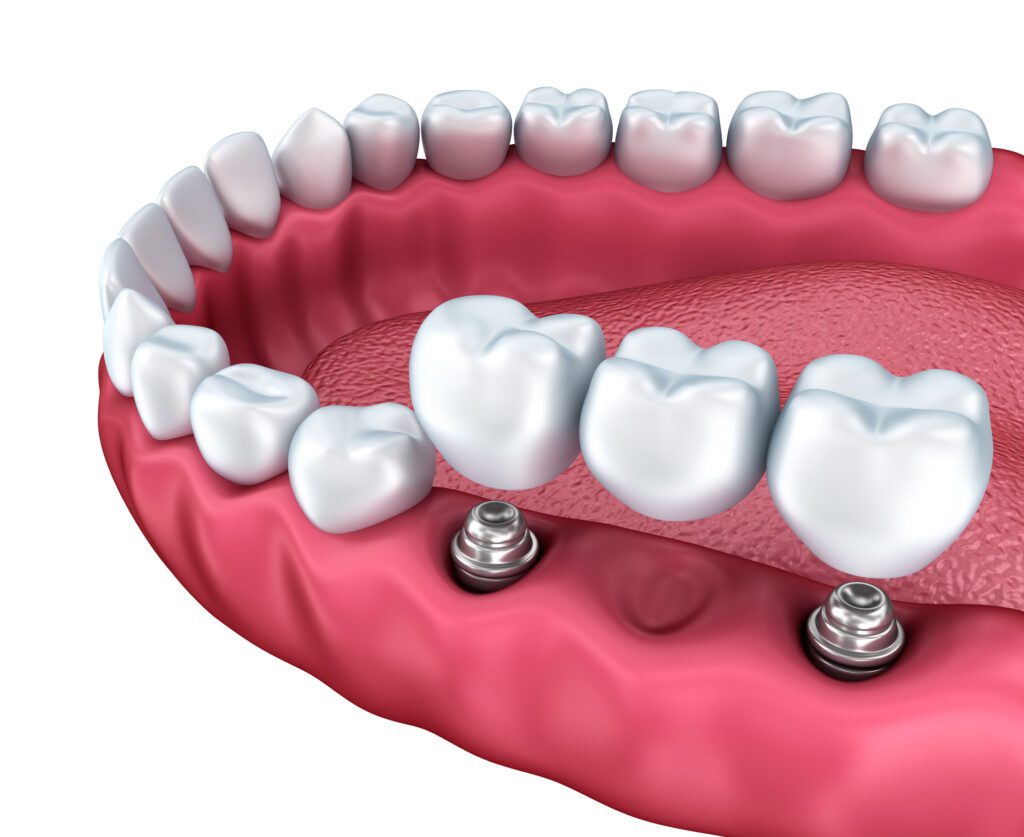 implant supported bridge in Towson, MD