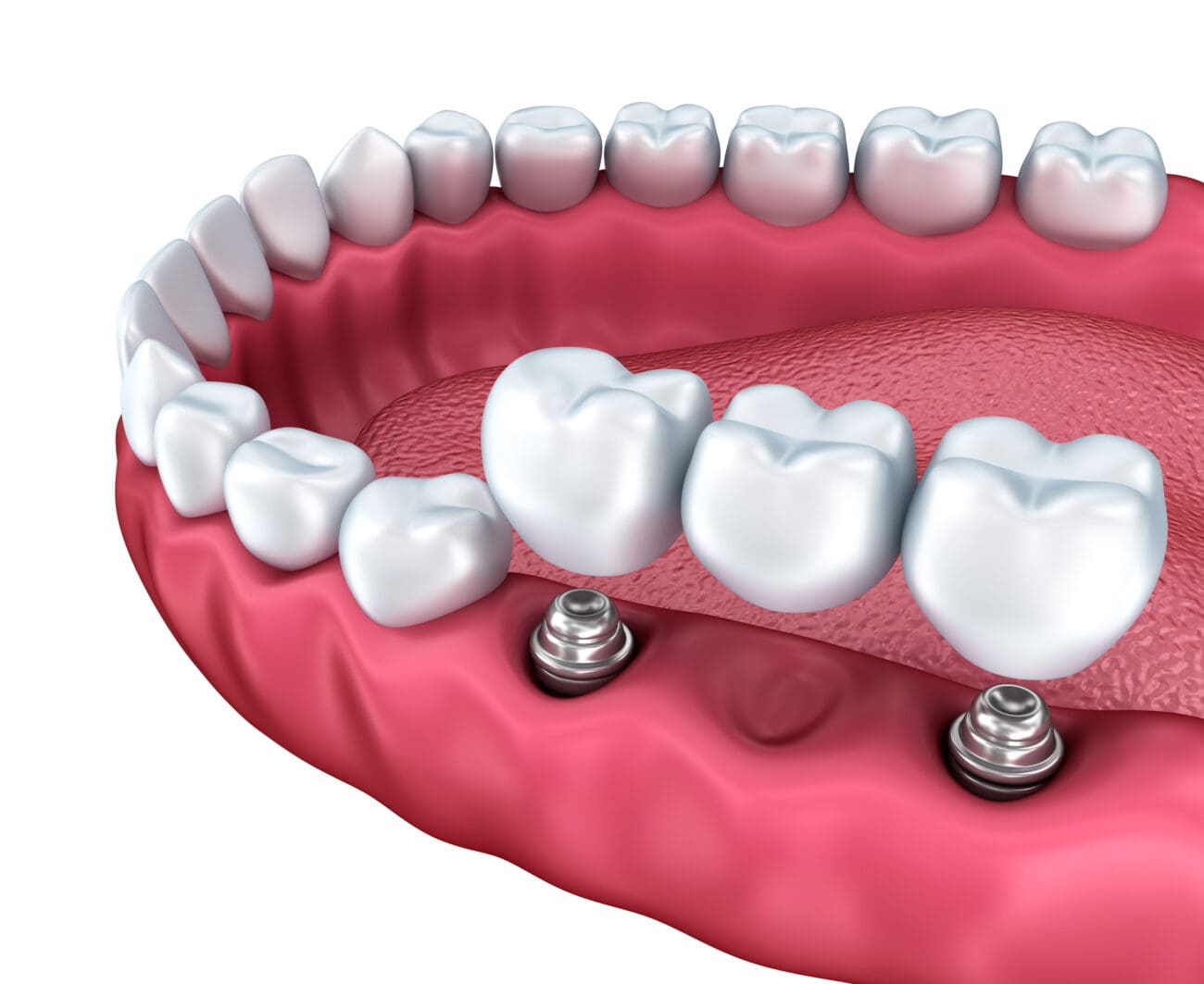 Key Sentence Dentist 2026 基礎POINT講座 Implant-Supported Bridge Towson MD | Multiple Dental Implants