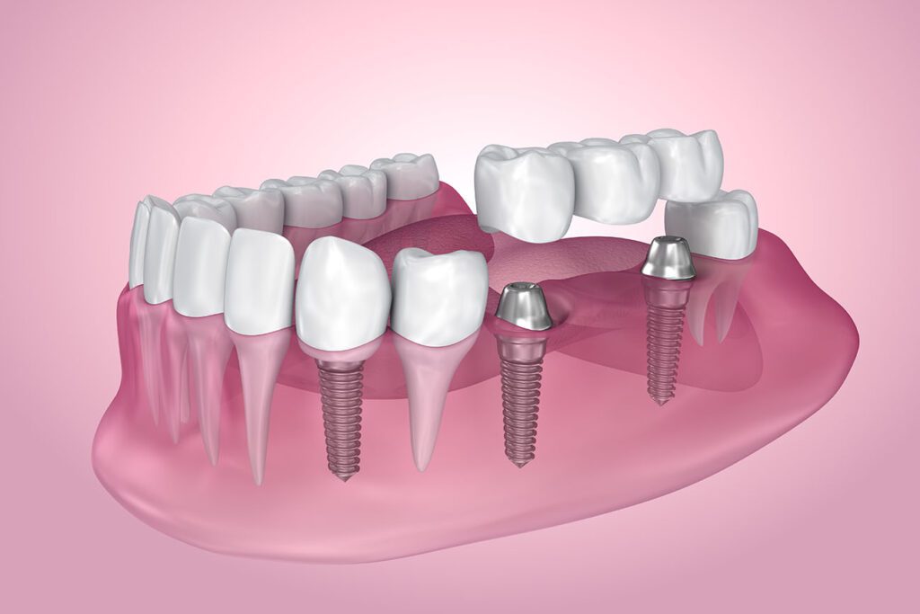 DENTAL IMPLANTS in TOWSON MD may require additional treatment before placement