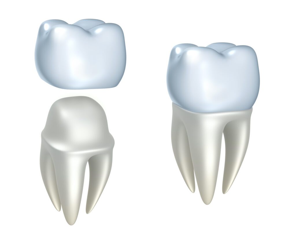 DENTAL CROWNS in TOWSON MD are often the best treatment for protection and preservation