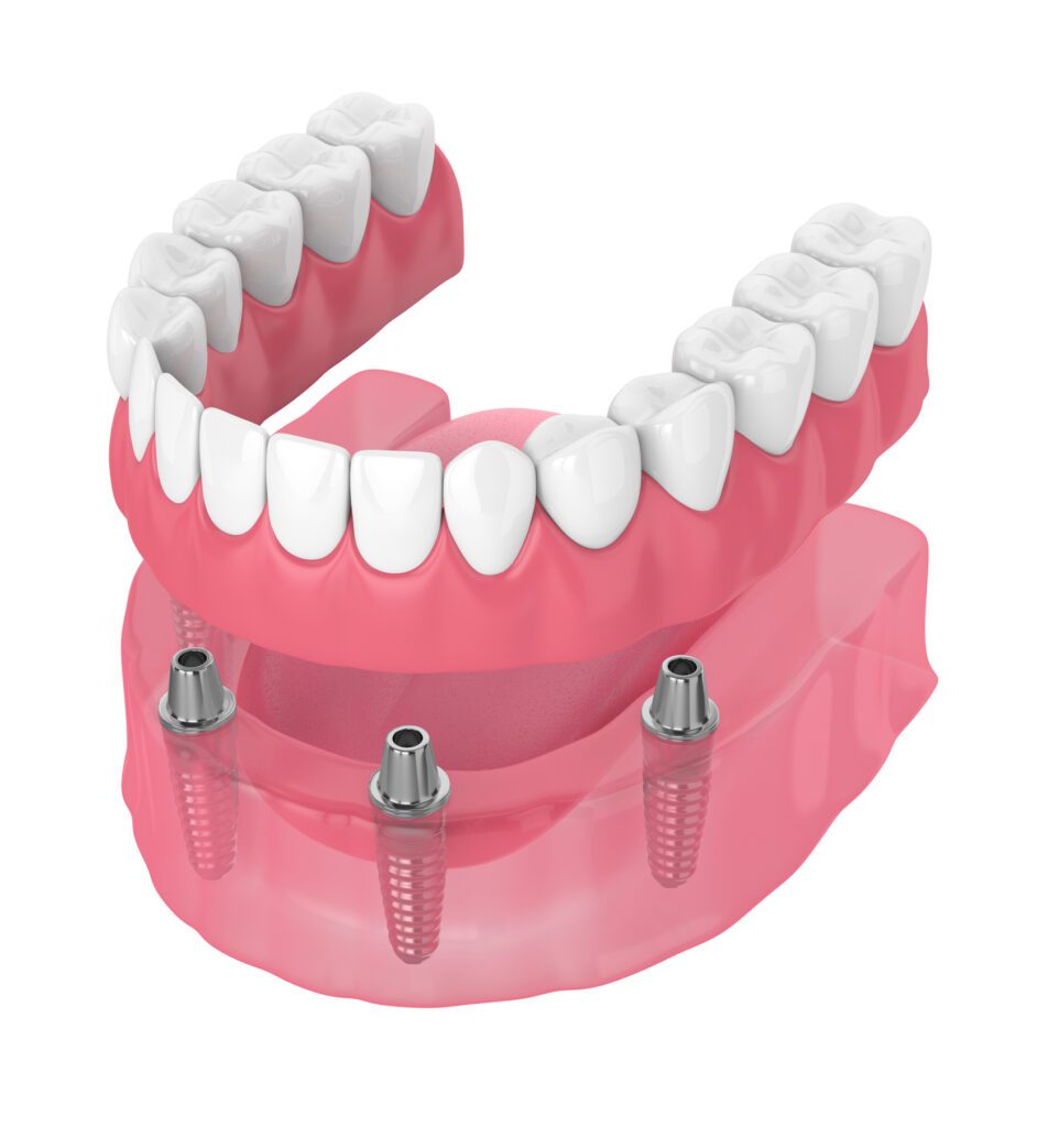 Full mouth dental implants could restore your smile and improve overall oral health after major tooth loss.