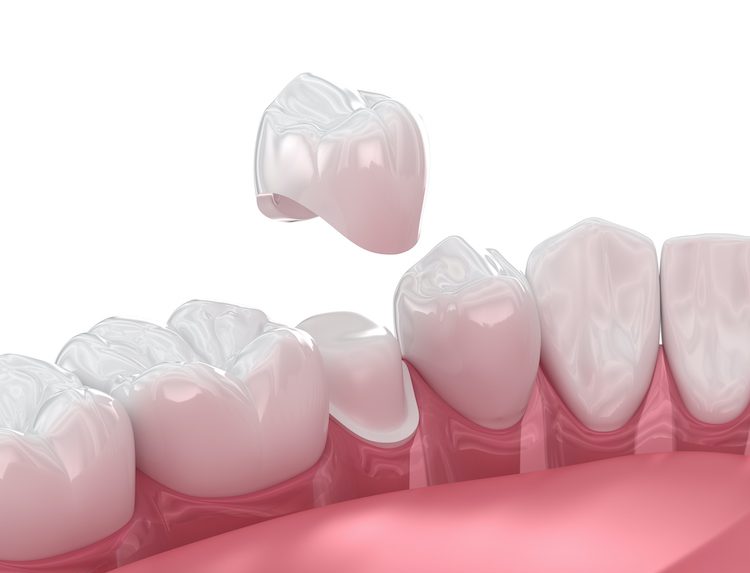 Understanding the signs that indicate you may need a dental crown can help you address issues before they become more serious.