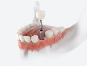 Dental Implants vs. Bridges: Which Is Right for You? in Towson, MD